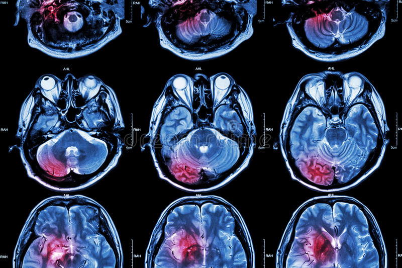 Brain MRI